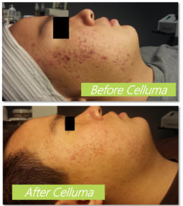 Celluma es la solución al acné