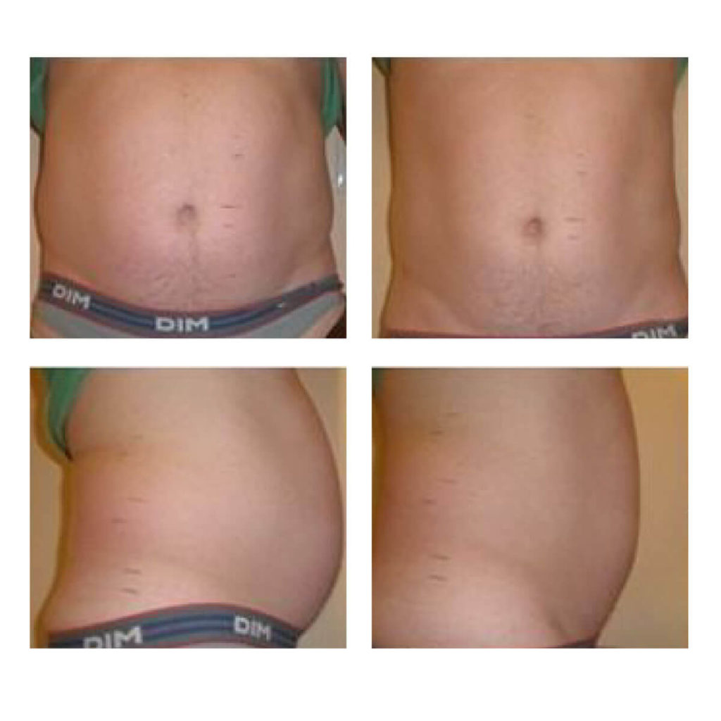 Comparativa de antes y después de un tratamiento corporal para hombre. Las imágenes de la izquierda muestran el abdomen con más volumen, y las de la derecha el mismo abdomen visiblemente más plano y reducido.