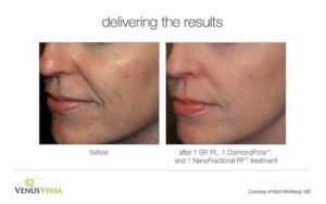 Eliminacion de Manchas con Fotofacial Venus Versa Comparativa de antes y después de un fotofacial con Venus Versa en Alcobendas, donde se ve la exitosa eliminación de manchas solares y el rejuvenecimiento de la piel.