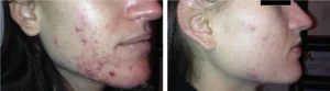 Comparativa de rostro femenino antes y después de tratamiento para acné moderado-severo