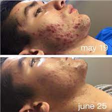 Mejora visible del acné inflamatorio en un joven tras tratamiento facial entre mayo y junio