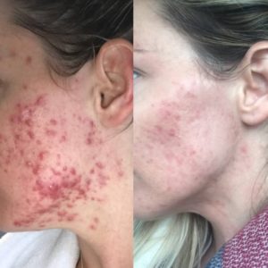 Reducción de acné inflamatorio en mejilla tras sesiones de tratamiento facial especializado