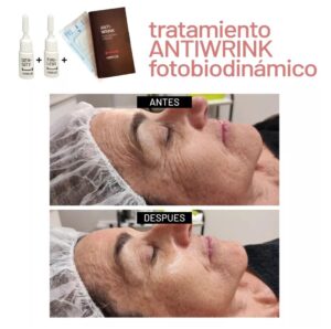 Rejuvenecimiento facial con terapia fotobiodinámica visible en zona periocular y pómulos