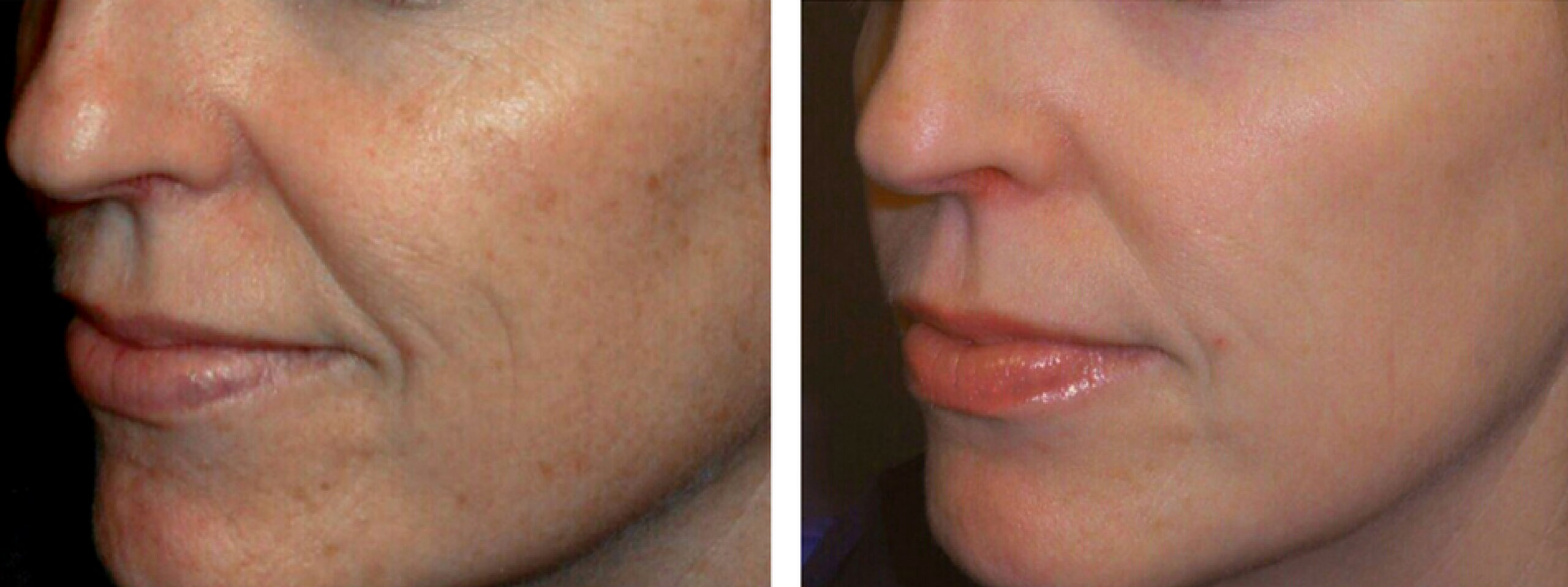 Comparativa del antes y después del tratamiento TriBella. La imagen de la izquierda muestra la piel con arrugas y flacidez, y la de la derecha una piel visiblemente más lisa, firme y rejuvenecida.
