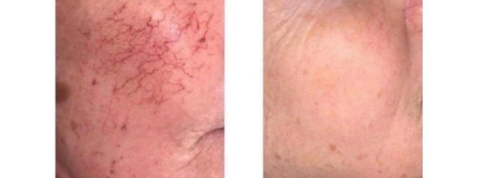 Comparativa del antes y después de un tratamiento para la couperose. La imagen de la izquierda muestra la piel con venas rojas visibles, y la de la derecha la misma piel con un tono uniforme y sin rojeces.