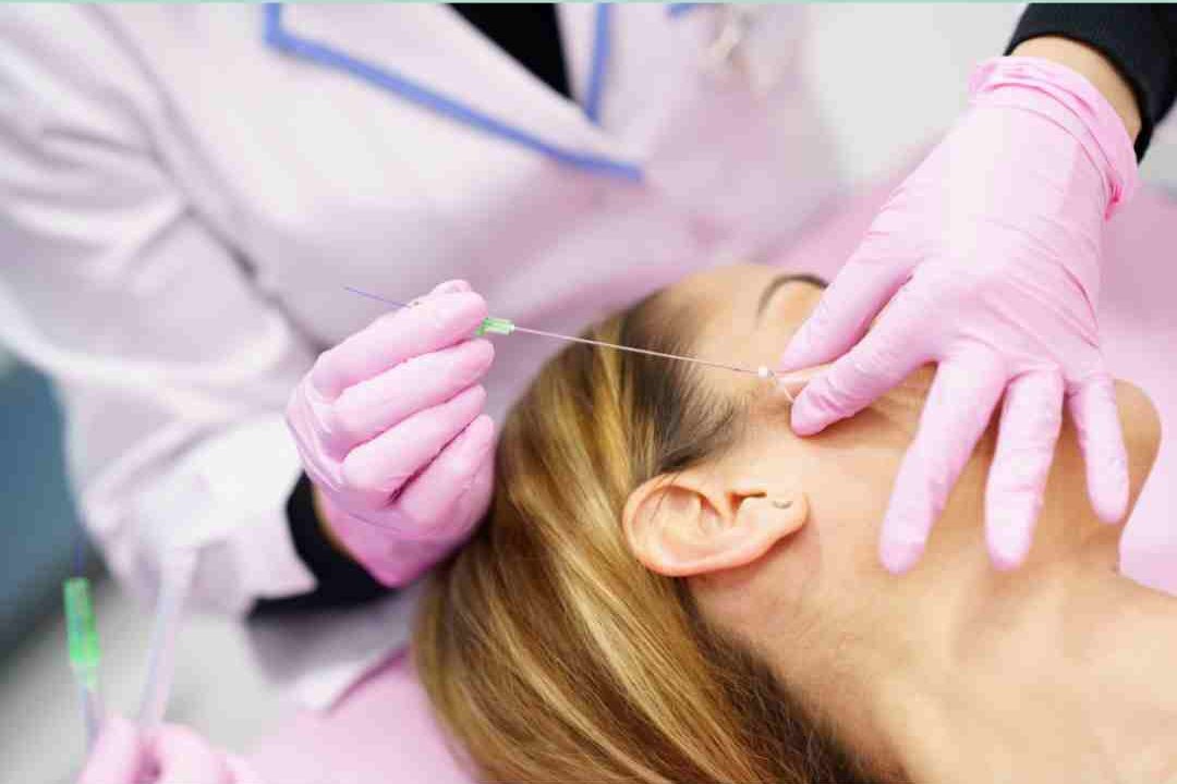 Aplicación de hilos tensores en rostro como tratamiento de rejuvenecimiento facial