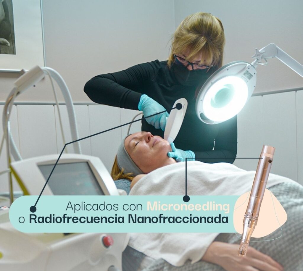 Infografía que muestra los métodos de aplicación del tratamiento con exosomas en Estética Tupiel: Microneedling (Dermapen) o Radiofrecuencia Nanofraccionada.