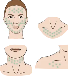 Ilustración de las zonas de aplicación de tratamiento de la piel del rostro, cuello y escote, disponible en Estética Tupiel en Alcobendas.