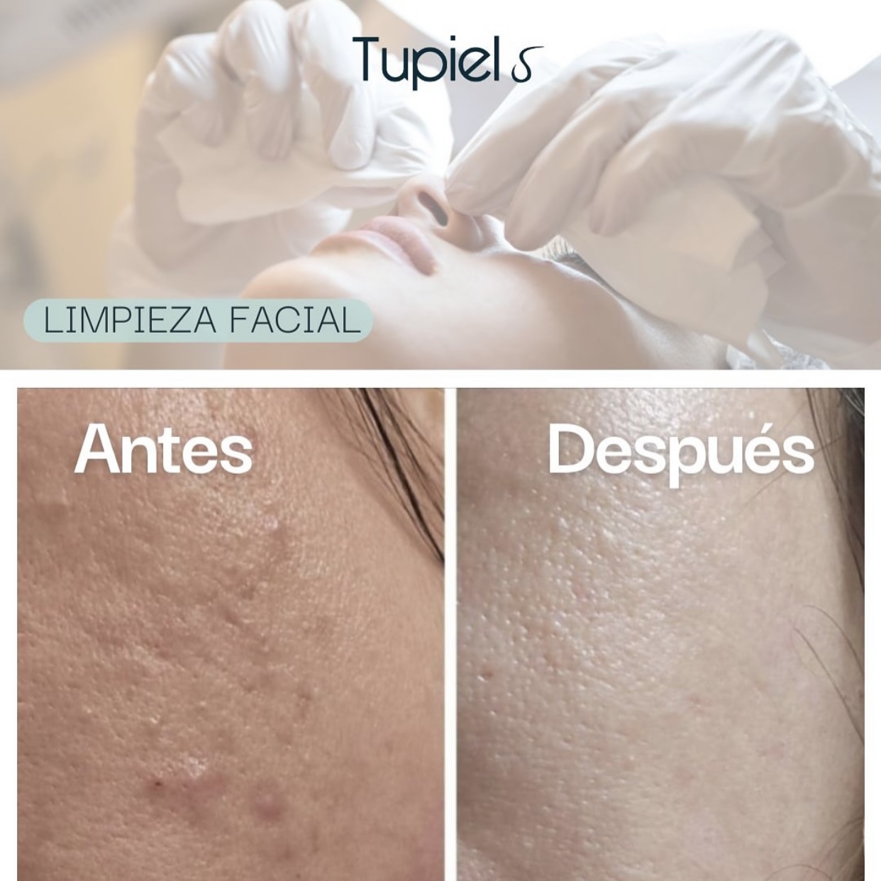 Antes y después de una limpieza facial en Tupiel, mostrando una piel con menos imperfecciones y textura más uniforme tras el tratamiento.