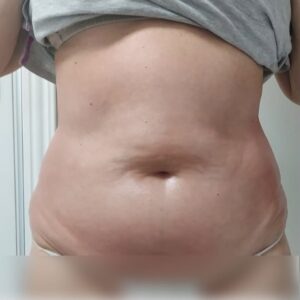 Abdomen femenino después del tratamiento corporal, con menor volumen y una apariencia más firme y definida.