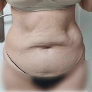 Abdomen femenino antes de un tratamiento corporal, con acumulación de grasa y ligera flacidez visible.