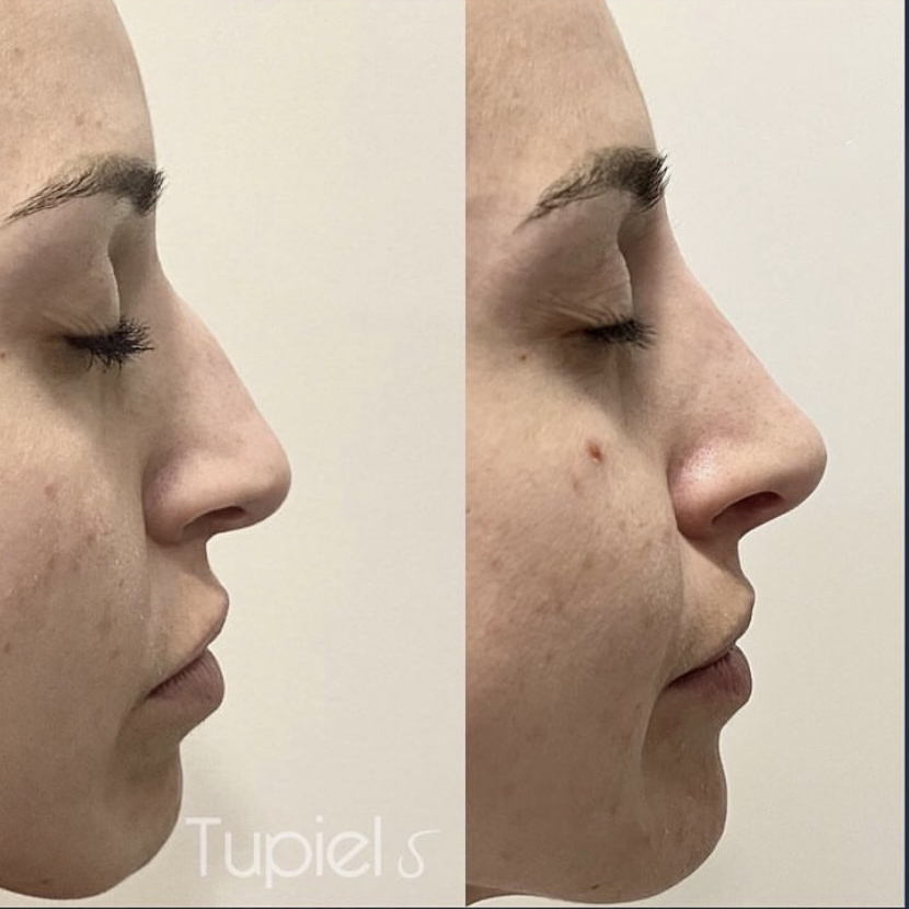 Comparativa antes y después de un tratamiento facial en perfil, mostrando mejora en la textura de la piel y el contorno de la zona del mentón.
