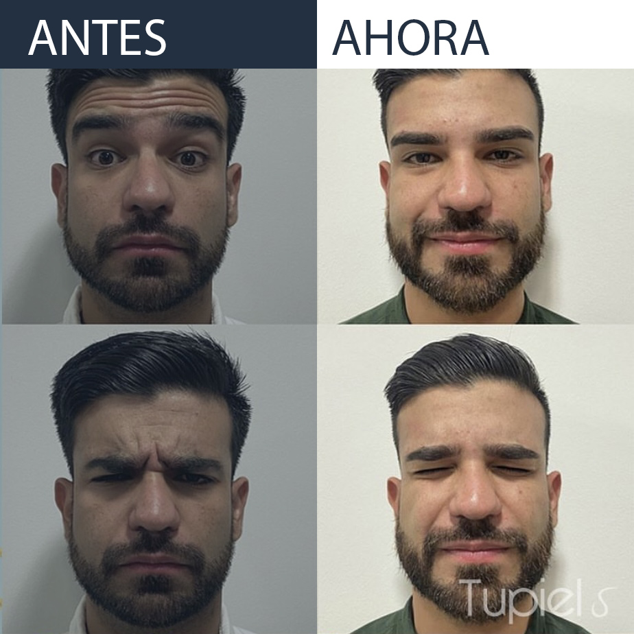 Comparativa antes y después de un tratamiento facial en un hombre, mostrando mejora en la expresión y la relajación de las líneas del entrecejo.