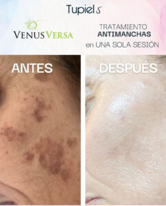 Comparativa antes y después de un tratamiento antimanchas con Venus Versa, mostrando reducción notable de manchas oscuras en una sola sesión.