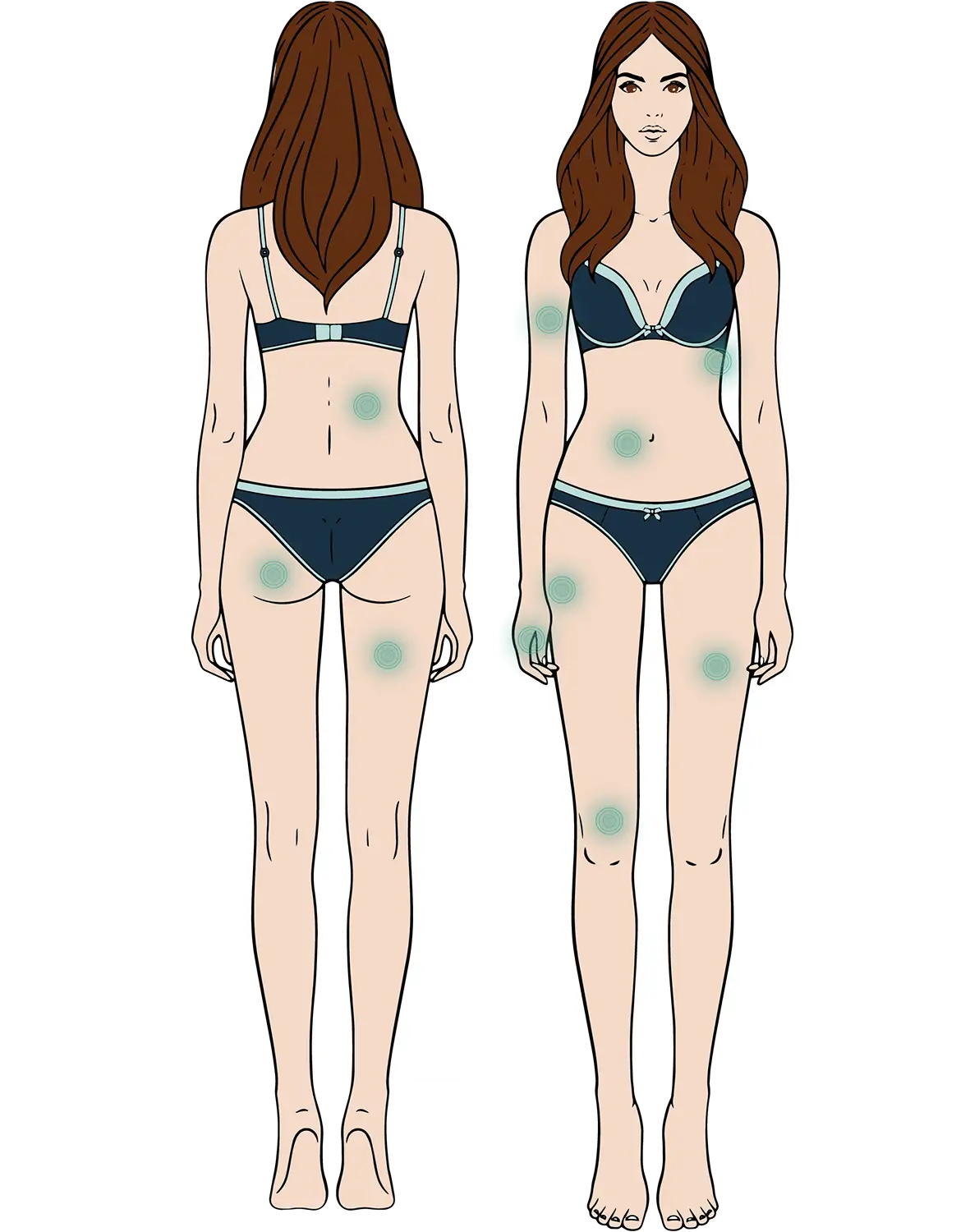 Diagrama de las zonas de aplicación para tratamientos, como abdomen, flancos y muslos.