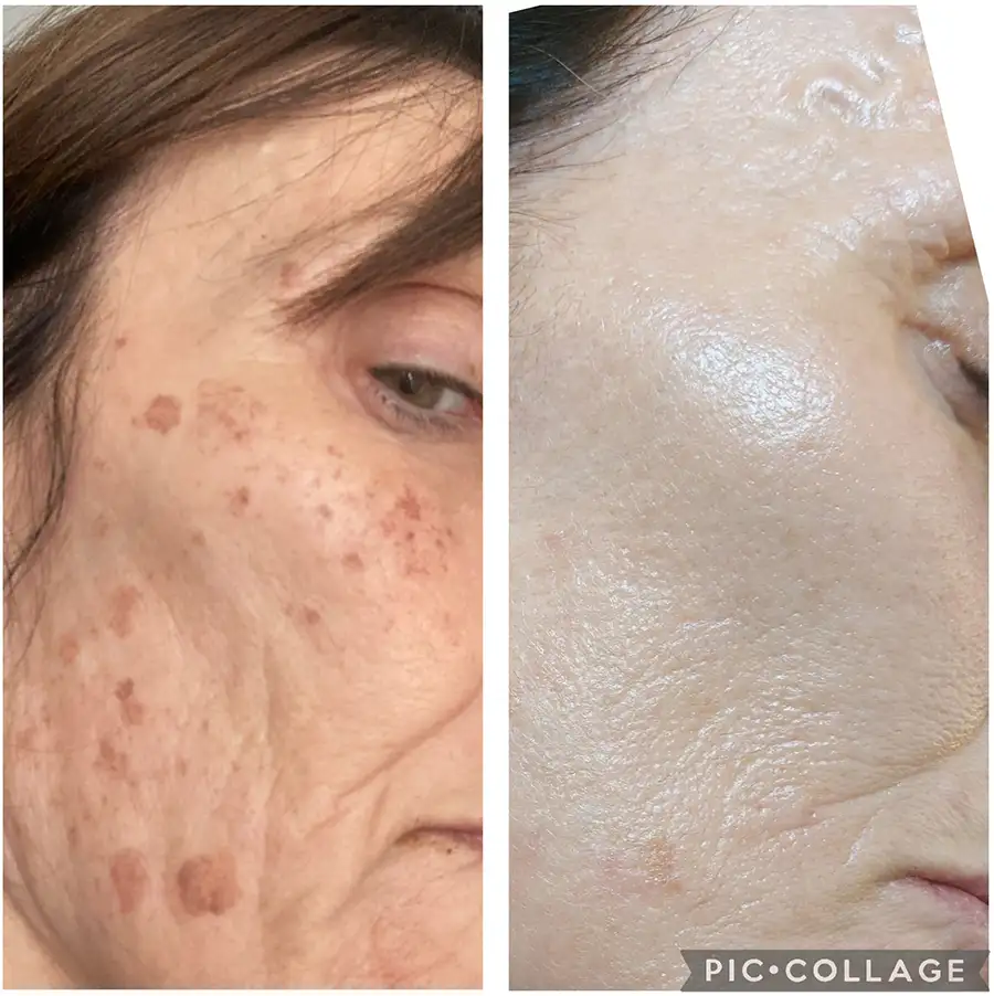 Antes y después de tratamiento láser para eliminar manchas solares en el rostro de una mujer madura