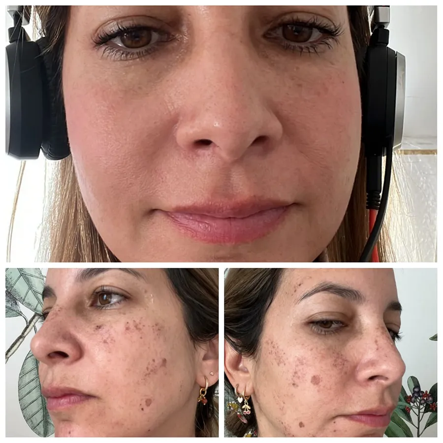Resultados visibles en rostro femenino tras tratamiento despigmentante para hiperpigmentación solar