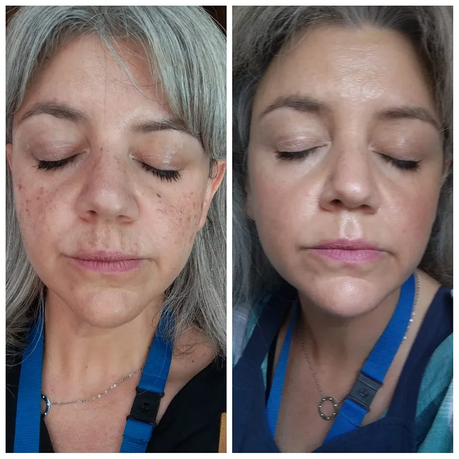 Comparativa facial antes y después de eliminar manchas solares con tratamiento láser en Estética Tupiel